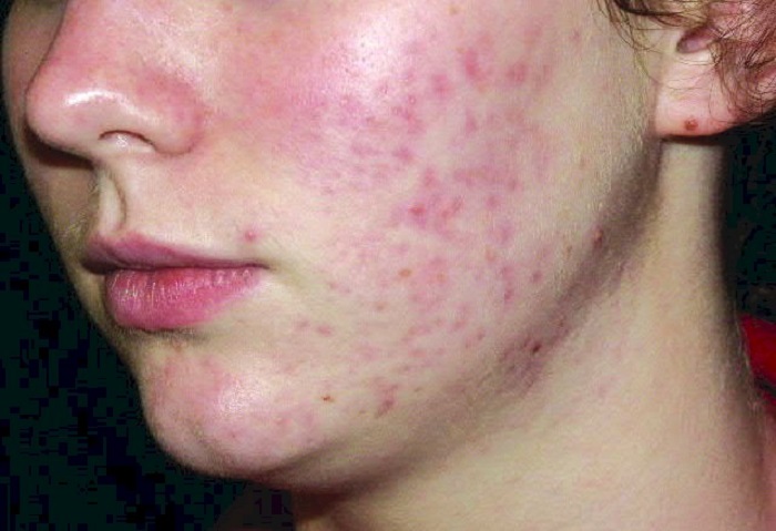 Photo Credit http://masterherald.com/acne-effective-treatment-is-already-being-produced-by-the-human-body-new-study-suggests/24501/
