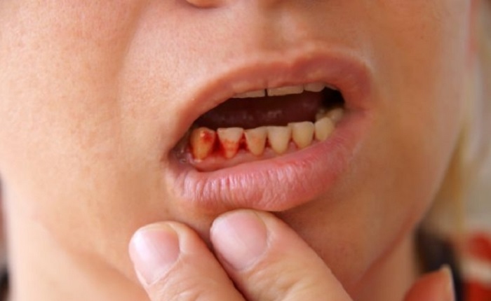 Photo Credit http://www.thedentalcheck.com/eating-disorders-and-your-teeth/